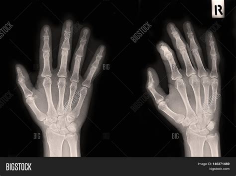 Xray Of Broken Finger