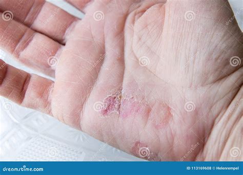 Extreme Sore Dry Cracked and Peeling Skin in the Hand. Stock Photo - Image of itchy, dermis ...