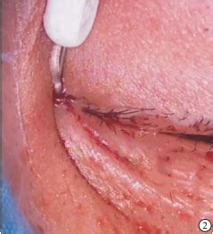 RS泪道引流管与单腔硅胶泪道引流管在泪小管损伤修复中的应用比较