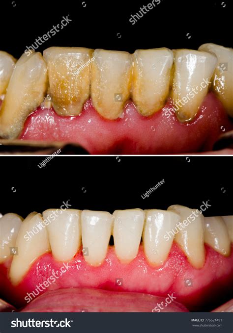 Calculus Teeth Before And After