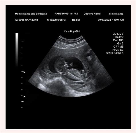12 Week Ultrasound - Ultrasounds
