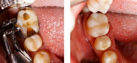 【牙医说第27期】“显微美学”补牙，到底是真“贵族”还是个噱头？_深圳爱康健口腔医院