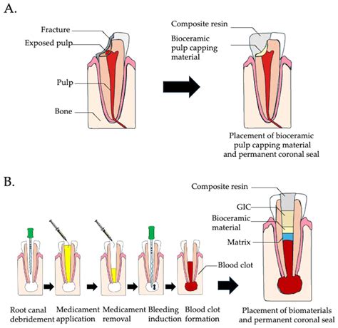 Endodontic Regeneration Therapy: Current Strategies and Tissue ...