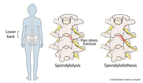 Spondylolysis and Spondylolisthesis | Boston Children's Hospital