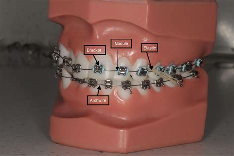 Orthodontics Braces Brackets