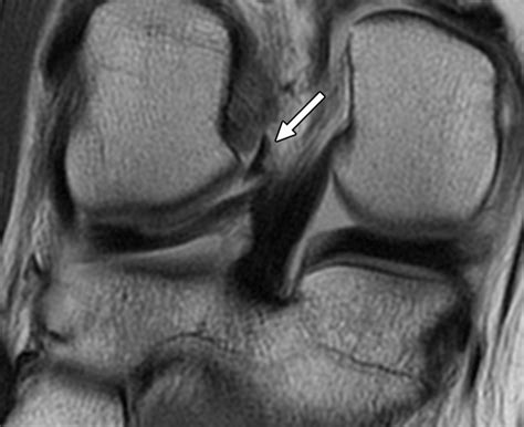 Lateral Meniscus Tear Posterior Horn