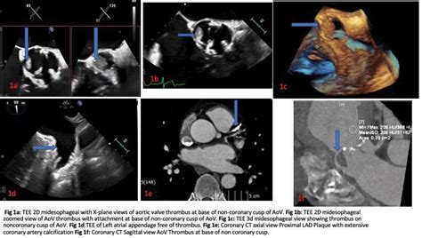 TRANSESOPHAGEAL ECHOCARDIOGRAM (TEE) PRIOR TO CARDIOVERSION (CV)- LOOK AT THE LEFT ATRIAL ...
