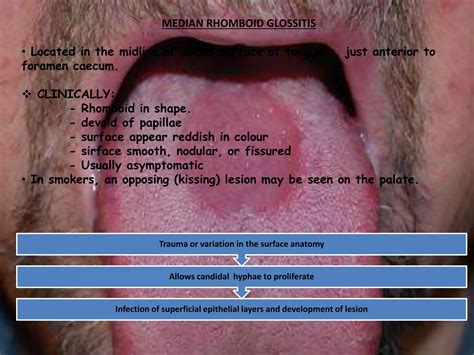 Oral pathology ... fungal infections 2 | PPTX