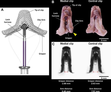 Insights Into Interaction Between Clip Device and the Mitral Valve Apparatus in the Human Heart ...