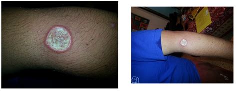 Review of Leishmaniasis Treatment: Can We See the Forest through the Trees?