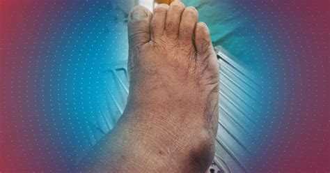 Ace the Case: A 78-Year-Old Man With Acute Onset of Right Ankle Pain ...