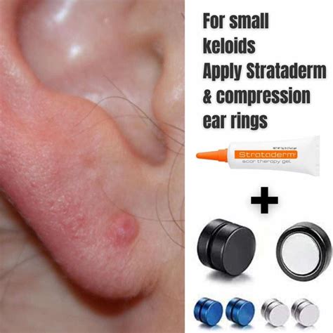 Earrings After Keloid Removal at Julian Romilly blog