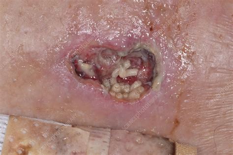 Maggots in leg ulcer in female patient - Stock Image - C059/5600 ...