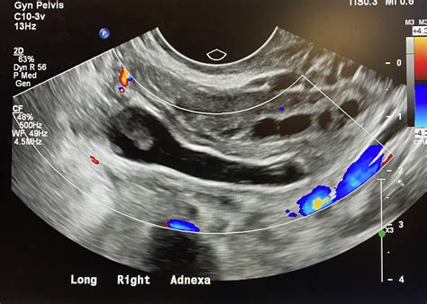 Appendicitis seen on transvaginal ultrasound : r/Radiology