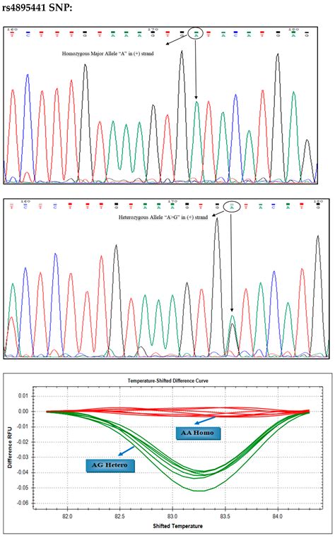 Disease-Modifying Effect of HBS1L-MYB in HbE/β-Thalassemia Patients in ...