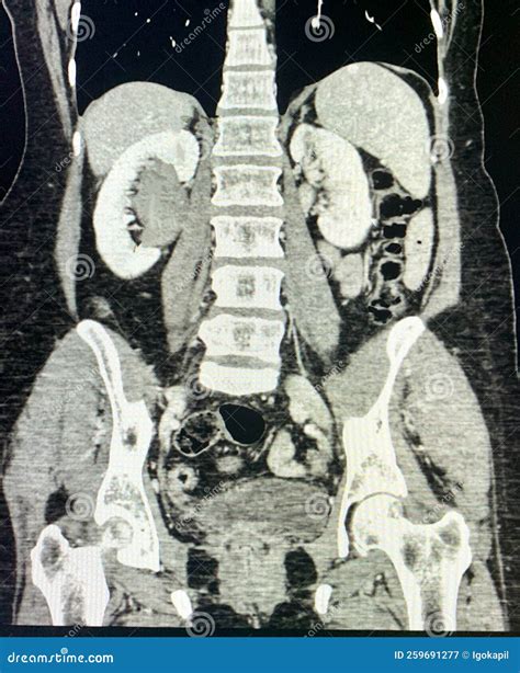 Modern Ct Scan of Renal Hydronephrosis Pathology Stock Image - Image of ...