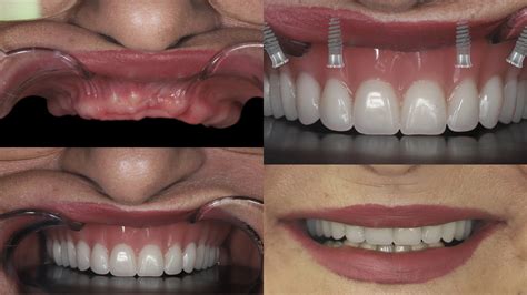 Full Dental Implants Full Mouth Dental Implants Cost, Procedure, And