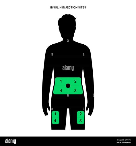 Insulin injection sites, illustration Stock Photo - Alamy