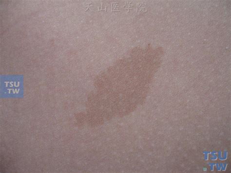 咖啡斑（cafe-au-lait spots）症状表现 - 皮肤病学 - 天山医学院
