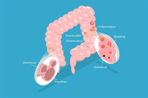 Can Diverticulitis Be Hereditary? GI Doctor Explains | Charleston GI