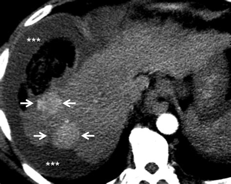 Computed Tomography: An Optimal Modality for the Detection of Nontraumatic Intraperitoneal and ...