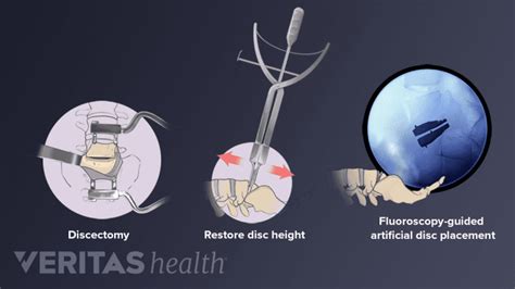 Image result for Disc Replacement Procedure