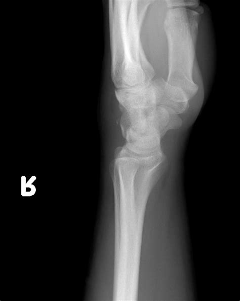 Fracture Of Triquetral Bone at Corinne Marx blog