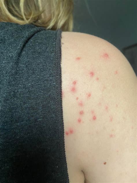 Exploding Bacne 的图像结果