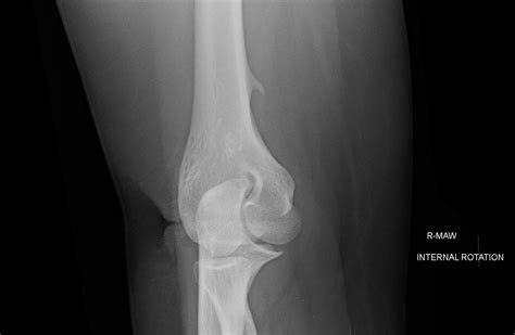 OrthoDx: Bony Growth Near Elbow - Clinical Advisor