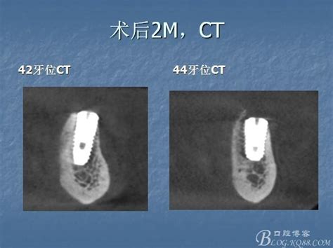 韩国登腾种植牙多少钱一颗？Dentium是几级钛后期稳定性怎么样_皓齿口腔网