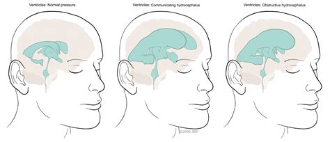 How Common Is Hydrocephalus