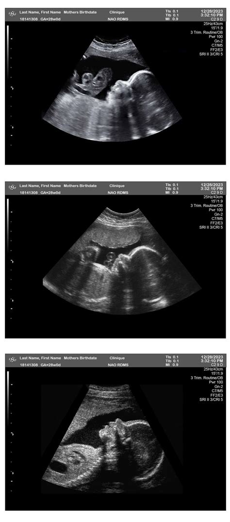 28 Weeks Ultrasound 3-Fetuses - Ultrasounds