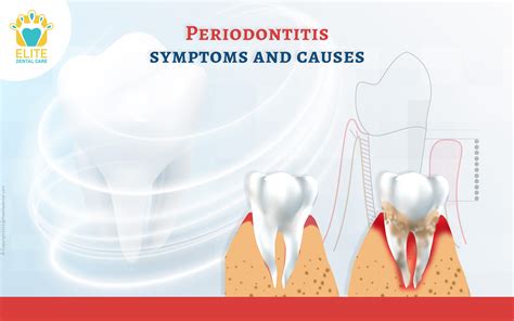 Different Types Of Periodontitis at Eve Michie blog