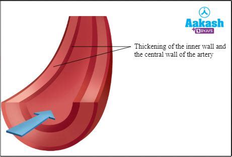 Myocardial Infarction: Symptoms, Causes, Underlying Physiology, People ...