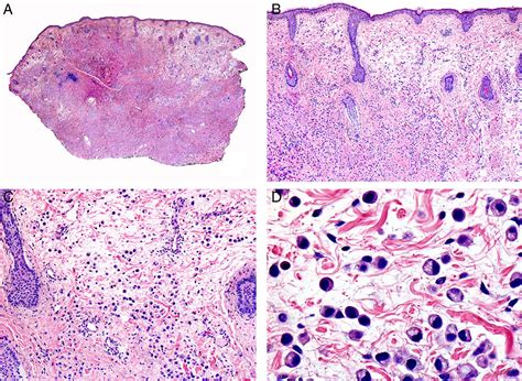 Treatment of Malignant Cutaneous Adnexal Neoplasms | Actas Dermo-Sifiliográficas