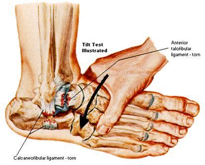 Ankle Sprains – Orland Park Orthopedics