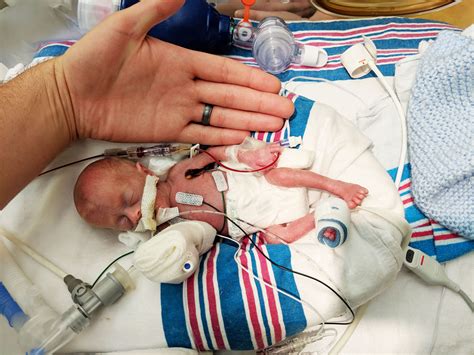 One Of America's Smallest 'Micro Preemie' Babies Discharged From Hospital