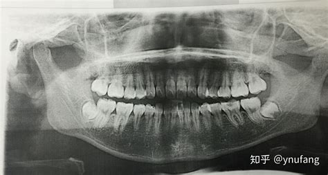 智齿长在哪里,智齿,正常长智齿的症状图片(第12页)_大山谷图库