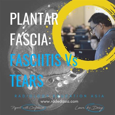 MRI PLANTAR FASCIA TEAR vs PLANTAR FASCIITIS (VIDEO) - Radedasia