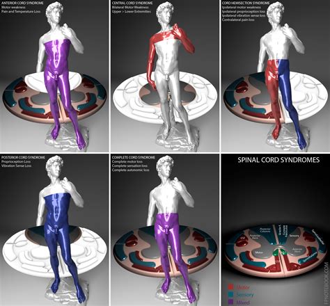 Posterior Cord Syndrome