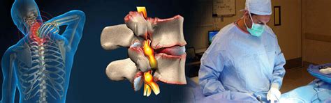 Spinal Stenosis Surgery In Philippines, Spinal Stenosis Surgery ...