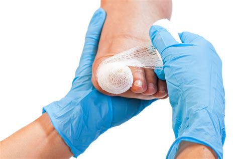 Toenail Removal Aftercare