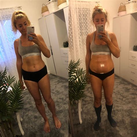 Image result for Laparoscopy Recovery