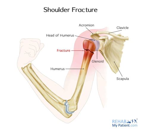 Shoulder Fracture | Rehab My Patient