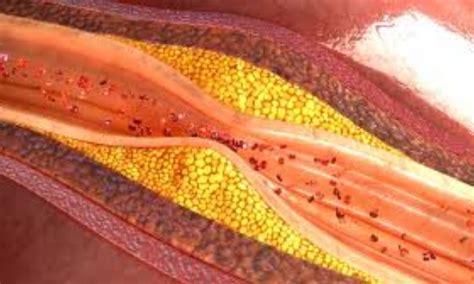 Obicetrapib promising add on treatment for high risk ASCVD patients on ...