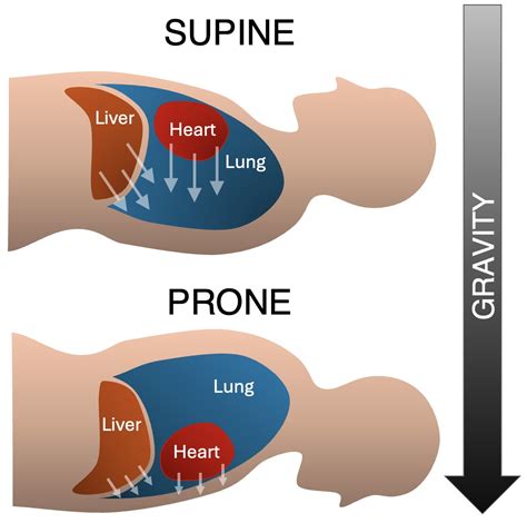 Prone Positioning - Trauma ICU