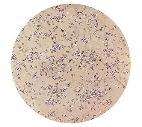 Yeast In Urine