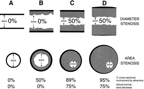 How Big Are Coronary Atherosclerotic Plaques That Rupture? | Circulation