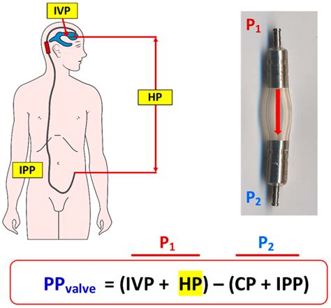 How to Choose a Shunt for Patients with Normal Pressure Hydrocephalus ...