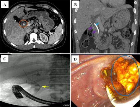 CT imaging features of bile duct stent complications - Clinical Imaging
